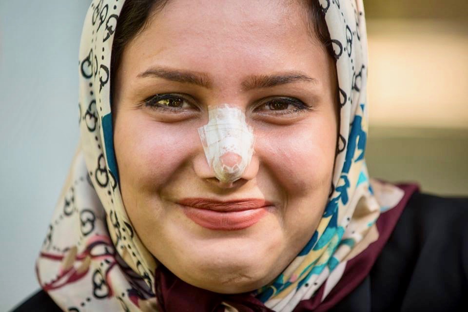 rinoplastica donne iraniane